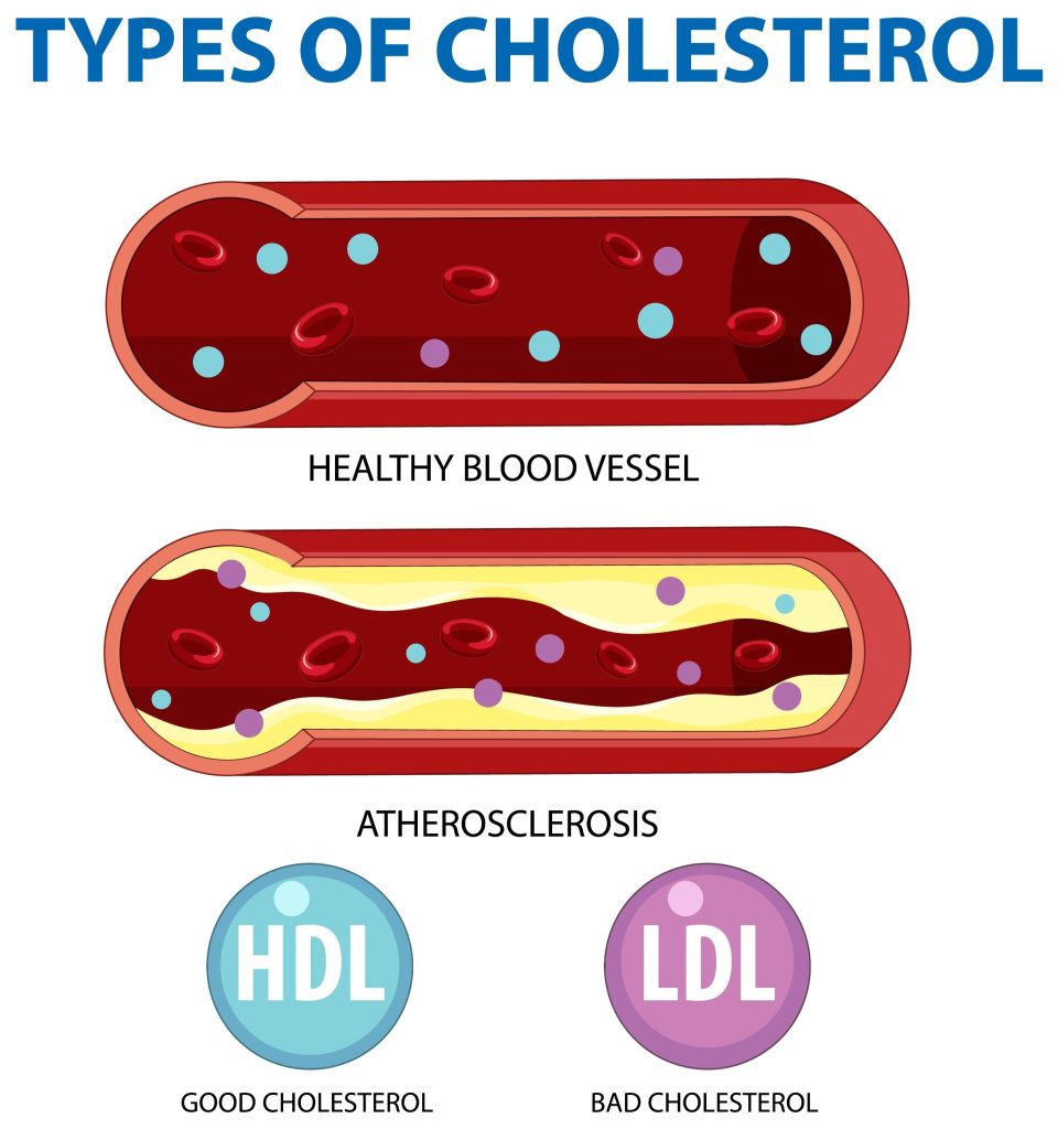 Typesofcholesterol