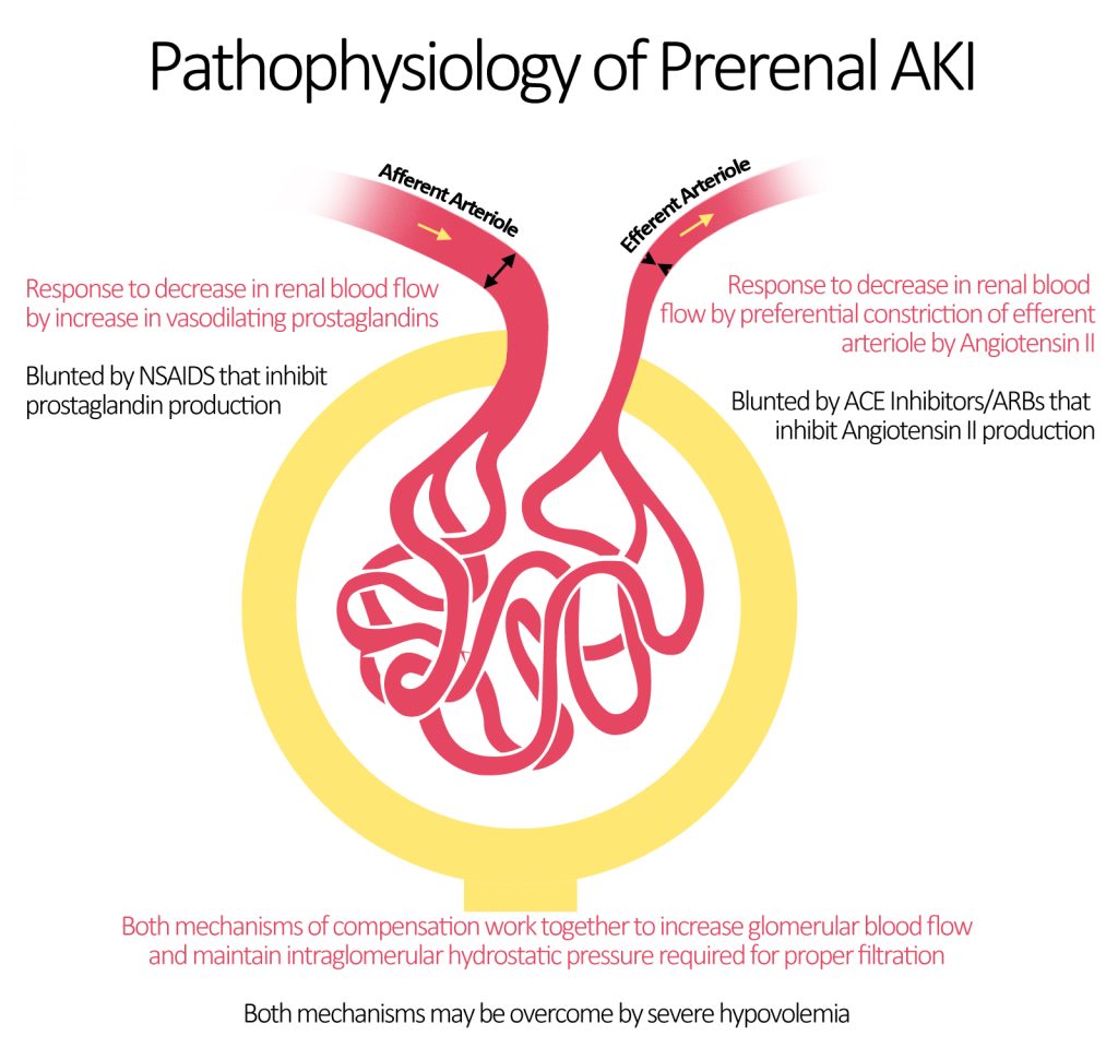 Pathophysiology of Prerenal AKI